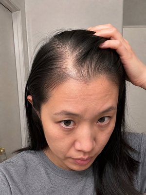 Before — hair thinning from lupus