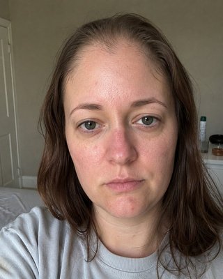 Before — severe front hairline thinning